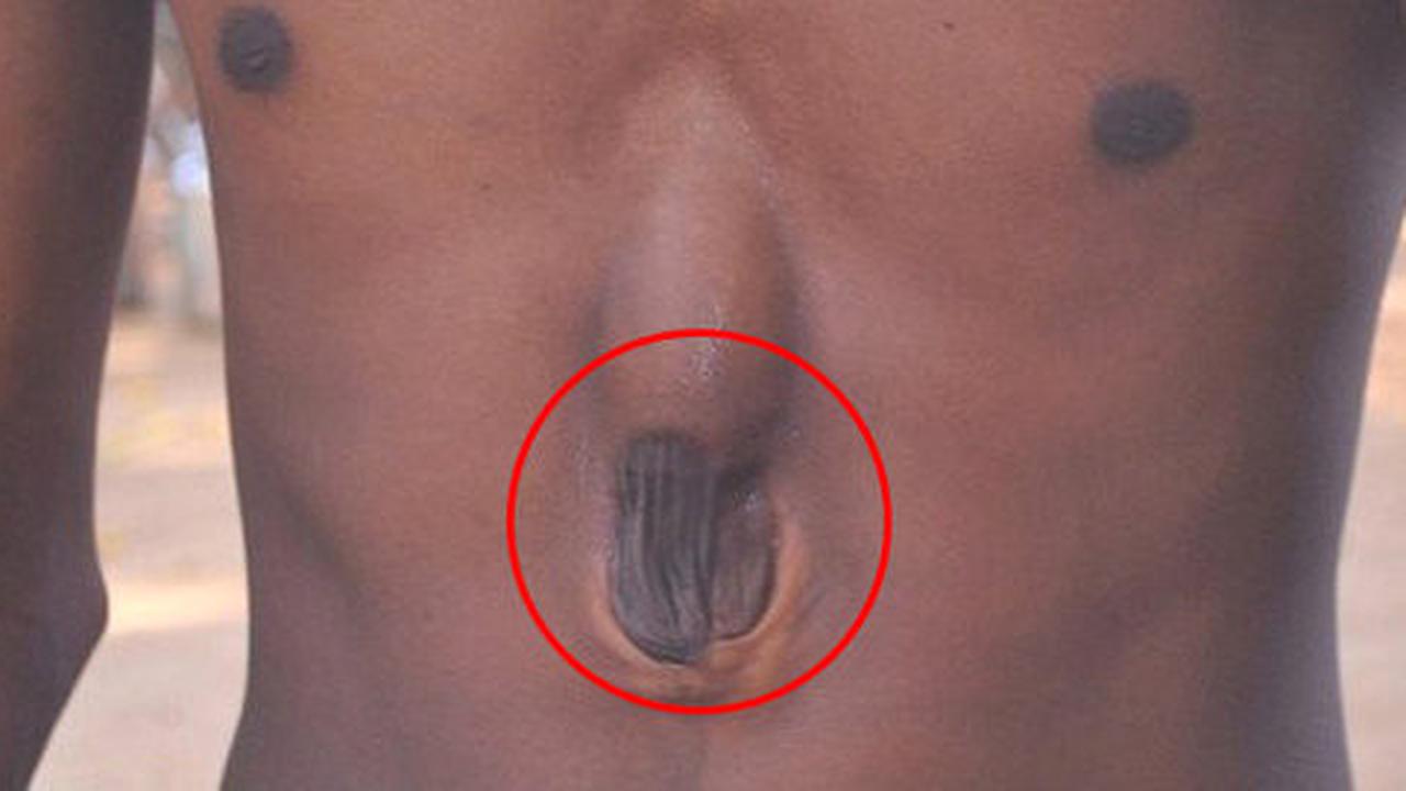 Langka! Pria ini tumbuh dengan kondisi jantung di luar rusuk