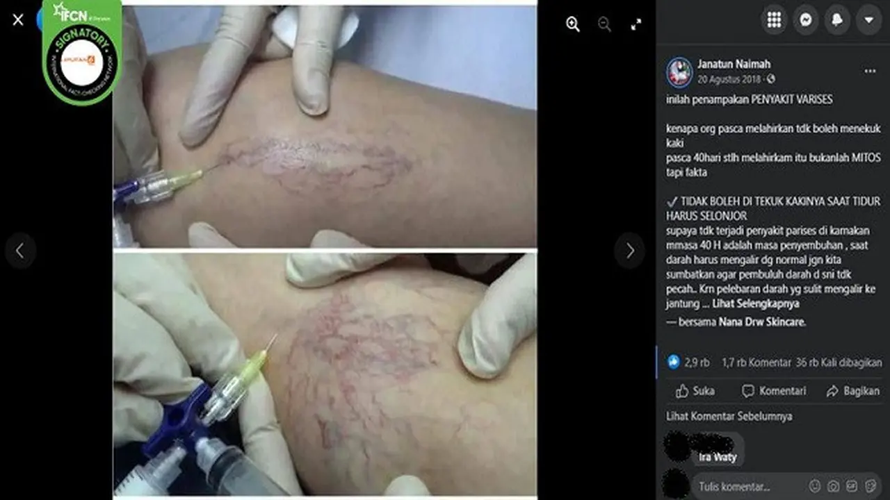 Gambar Tangkapan Layar Klaim Menekuk Kaki Usai Melahirkan Dapat Menyebabkan Penyakit Varises (sumber: Facebook).
