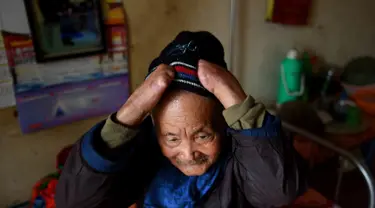 Penderita kusta Nguyen Quang Chieu duduk di ranjang kompleks RS Van Mon Leprosy, Thai Binh, Vietnam, Minggu (20/1). RS Van Mon Leprosy merupakan rumah sakit khusus kusta tertua di Vietnam. (Manan Vatsyayana/AFP)