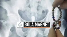 Seorang pria berusia 58 tahun harus menjalani operasi setelah memasukkan 28 bola magnet ke dalam alat kelaminnya. Bola-bola itu saling menempel satu sama lain di dalam kandung kemih.