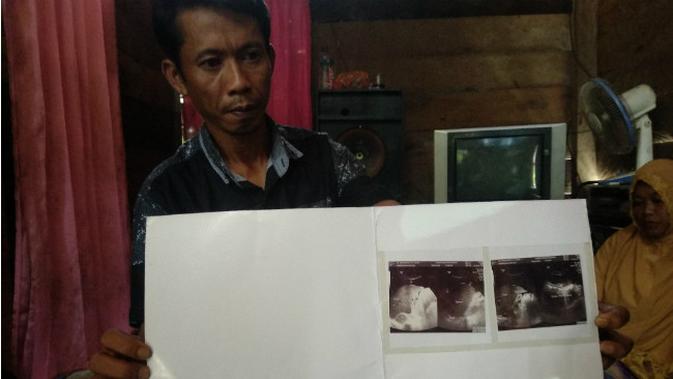 Surohim (33), ayah Adi memperlihatkan hasil foto X-ray dari rumah sakit terkait penyakit anaknya yang diduga terjadi penumpukan cairan di dalam perut. (Liputan6.com/ Ahmad Akbar Fua)