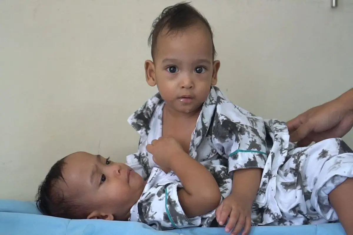 Bayi kembar siam