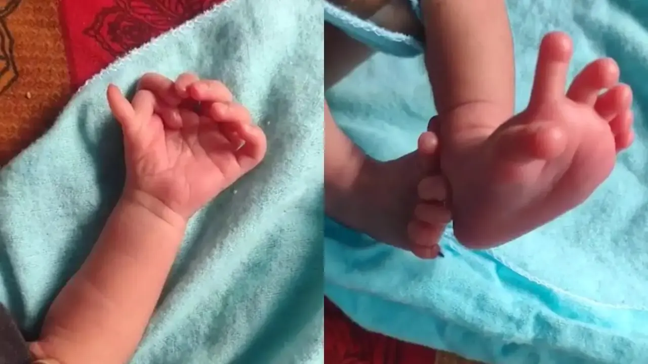 Bayi Perempuan di India Memiliki 26 Jari