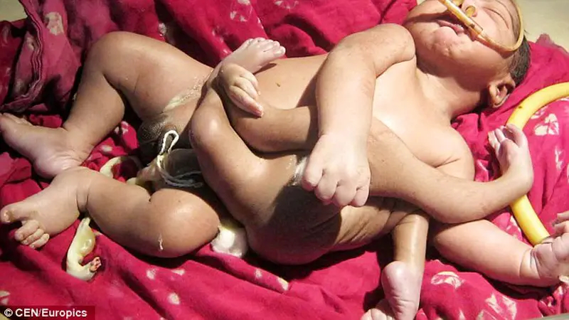 Heboh Bayi Punya Kaki &amp; Tangan 2 Pasang, Titisan Dewa India?