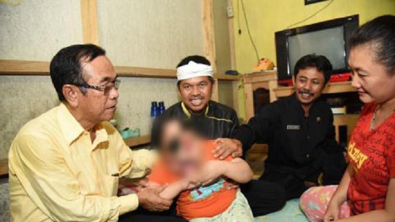 Bocah Ciamis Bertahan Hidup Enam Tahun Tanpa Tempurung Kepala