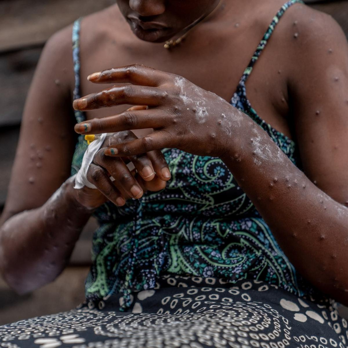 Wabah Mpox atau Cacar Monyet di Burundi