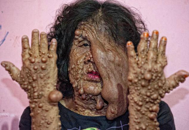 Tumor dan pembengkakan menutupi tubuh dan wajah Sarotin | Photo Copyright Dailymail/ Barcroft Me/ Sinar Sakti Image