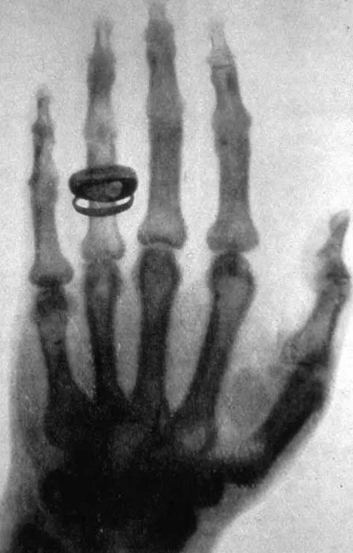 8 November 1895: Wilhelm Roentgen Menemukan X-Ray