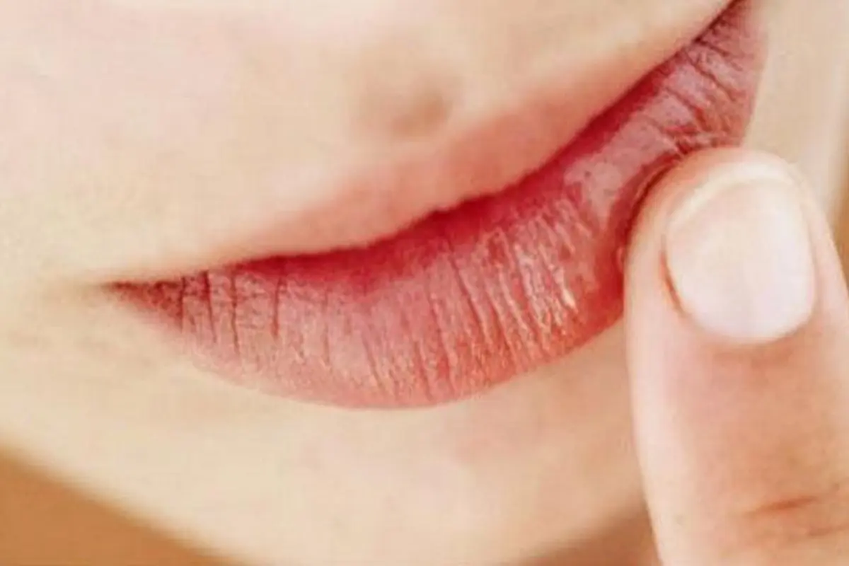Hindari Bibir Pecah-pecah Selama Puasa dengan 5 Cara Ini