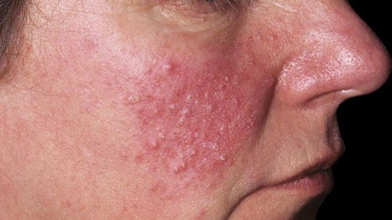 ilustrasi papulopustular rosacea