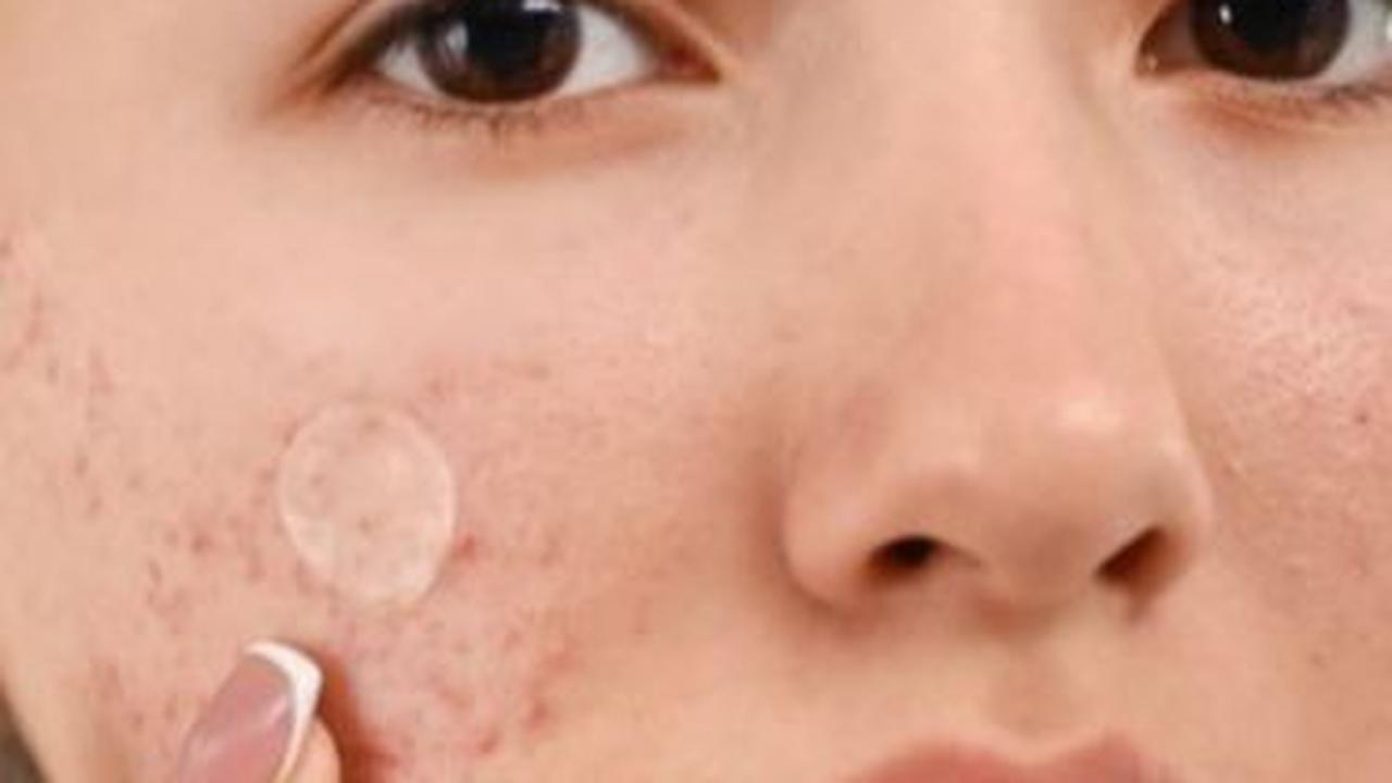 Terdapat tiga jenis acne patch yang perlu diketahui untuk memilih sesuai kebutuhan: