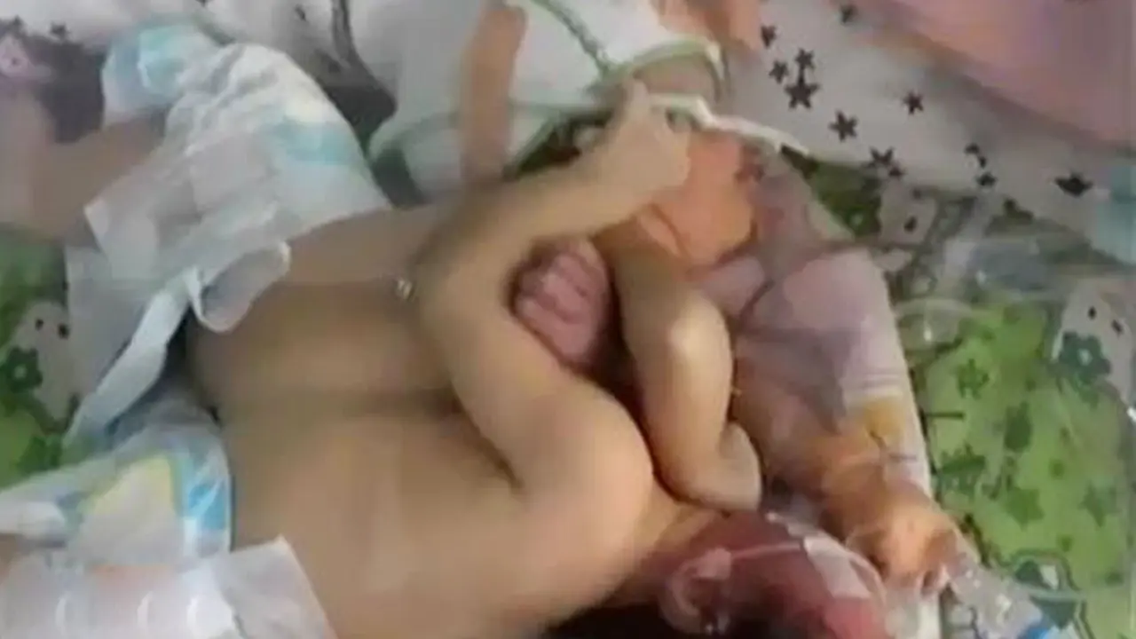  Bayi Kembar Siam di Tasik Butuh Biaya Operasi Pemisahan 