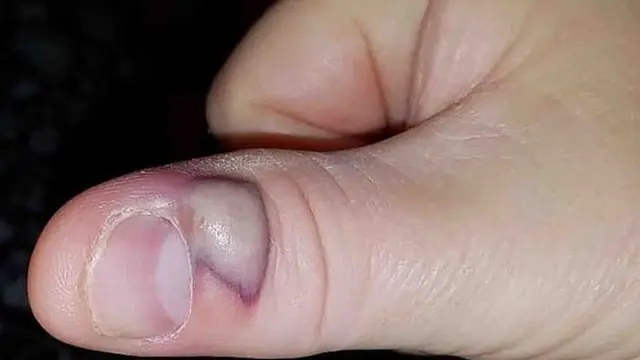 Sering Menggigit Kuku hingga Luka, Pria Ini Alami Nasib Tragis