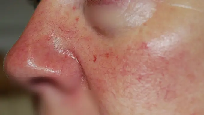 [Bintang] Urat halus di pipi