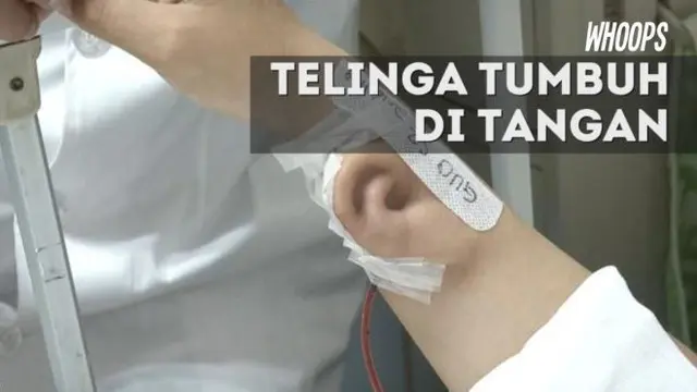 Nantinya telinga itu akan ditransplantasikan ke kepala Ji. Dengan begitu, kondisi fisik Ji bisa kembali seperti semula.