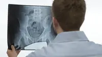 Kenali Penyakit Hernia, Penyebab dan Cara Mengobatinya Agar Tak Semakin Parah