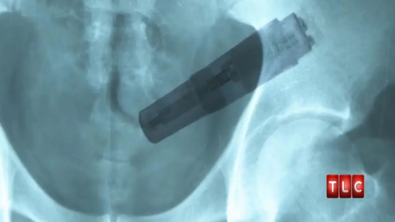 Pria Masuk UGR Gara-gara Vibrator Terjebak di Usus Besar