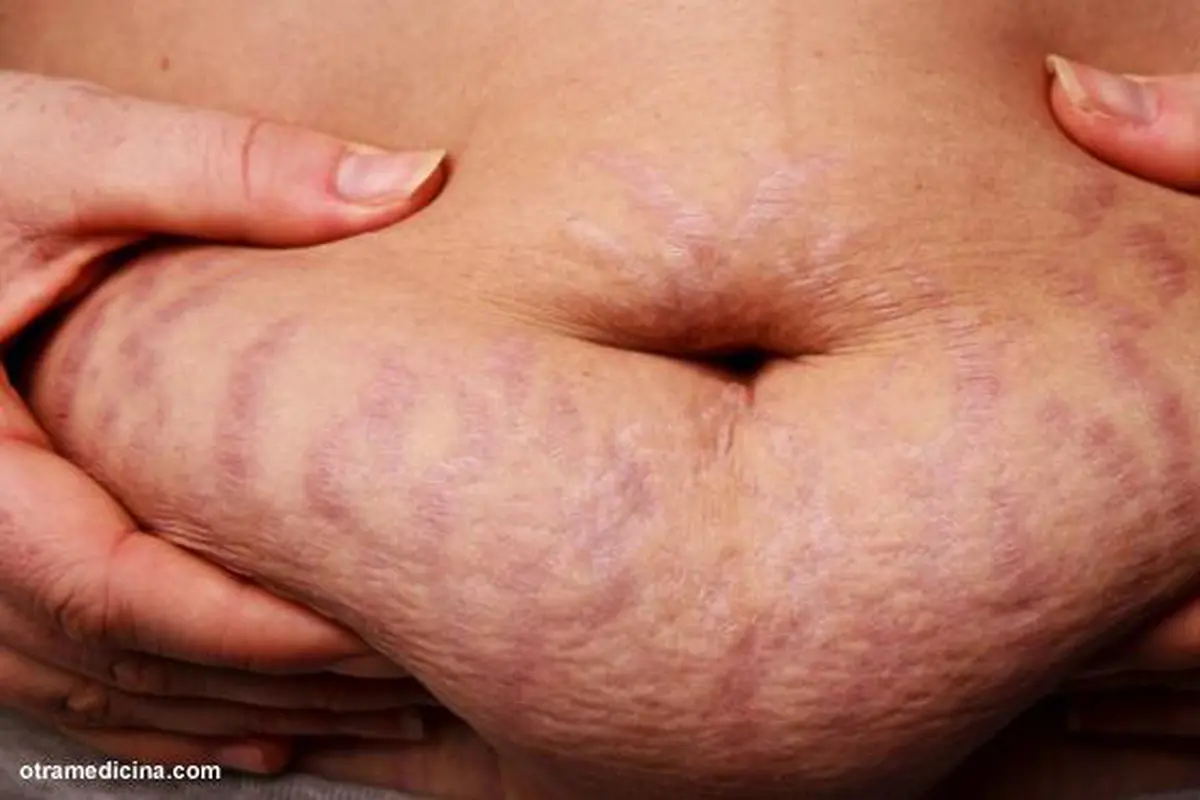Stretch Mark