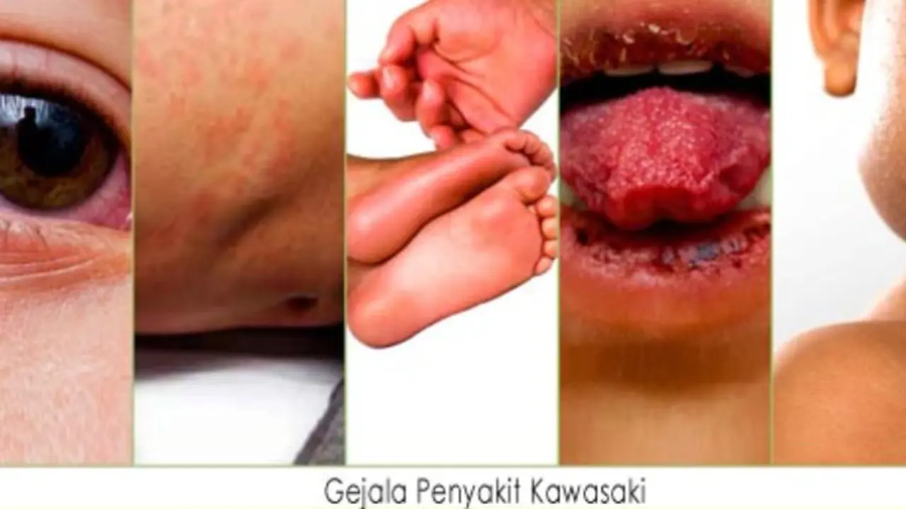 Waspadai Virus Kawasaki Landa Kesehatan Anak