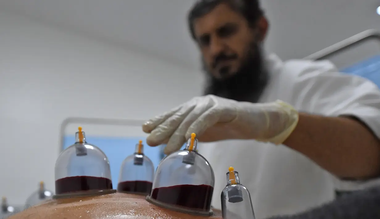 Spesialis melakukan pengobatan hijama atau terapi bekam basah kepada pasien di sebuah klinik di Ajman, Uni Emirat Arab, Kamis (15/8/2019). Hijama berasal dari istilah bahasa Arab yang berarti pelepasan darah kotor. (KARIM SAHIB/AFP)