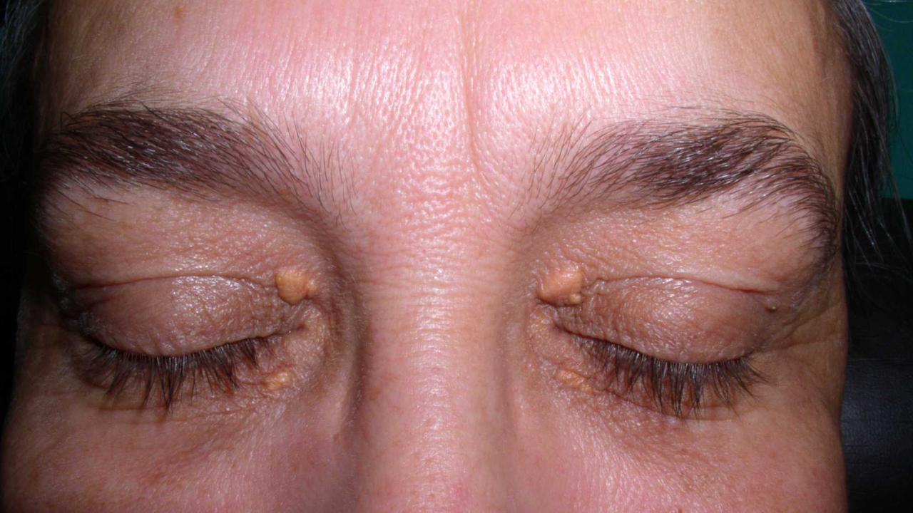 Awas Kolesterol Terlalu Tinggi Juga Bisa Menyebabkan Xanthelasma!