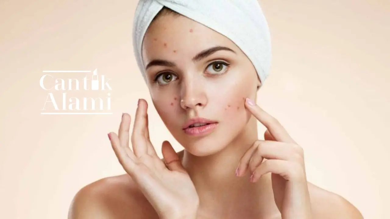 Cantik Alami: Mengatasi Wajah Kemerahan Akibat Jerawat