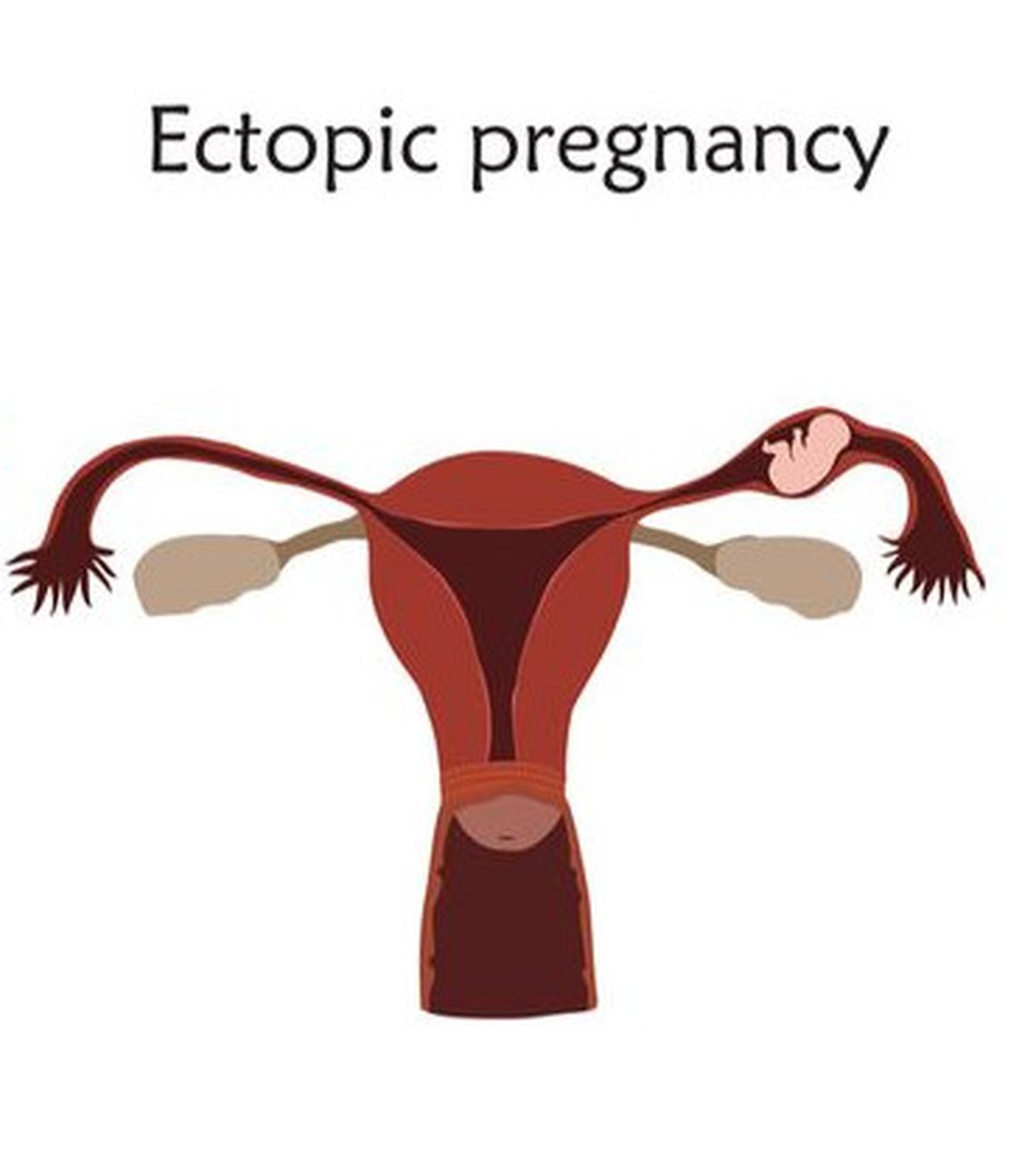 ilustrasi kehamilan ektopik