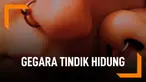 Gegara Tindik Hidung, Wanita Ini Berakhir Lumpuh