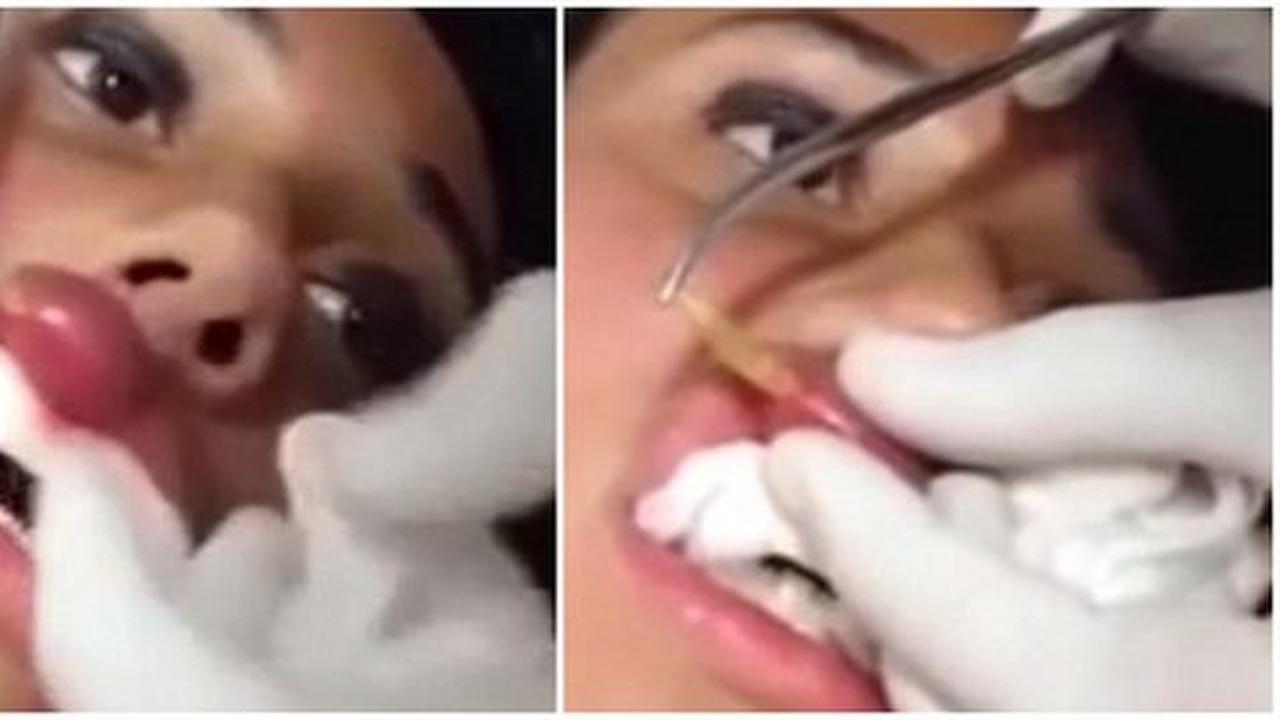 Video dokter keluarkan belatung di bibir wanita ini bikin merinding