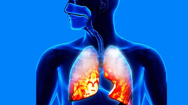 [Bintang] Apa Itu Pneumonia, Penyakit yang Menyerang Hillary Clinton