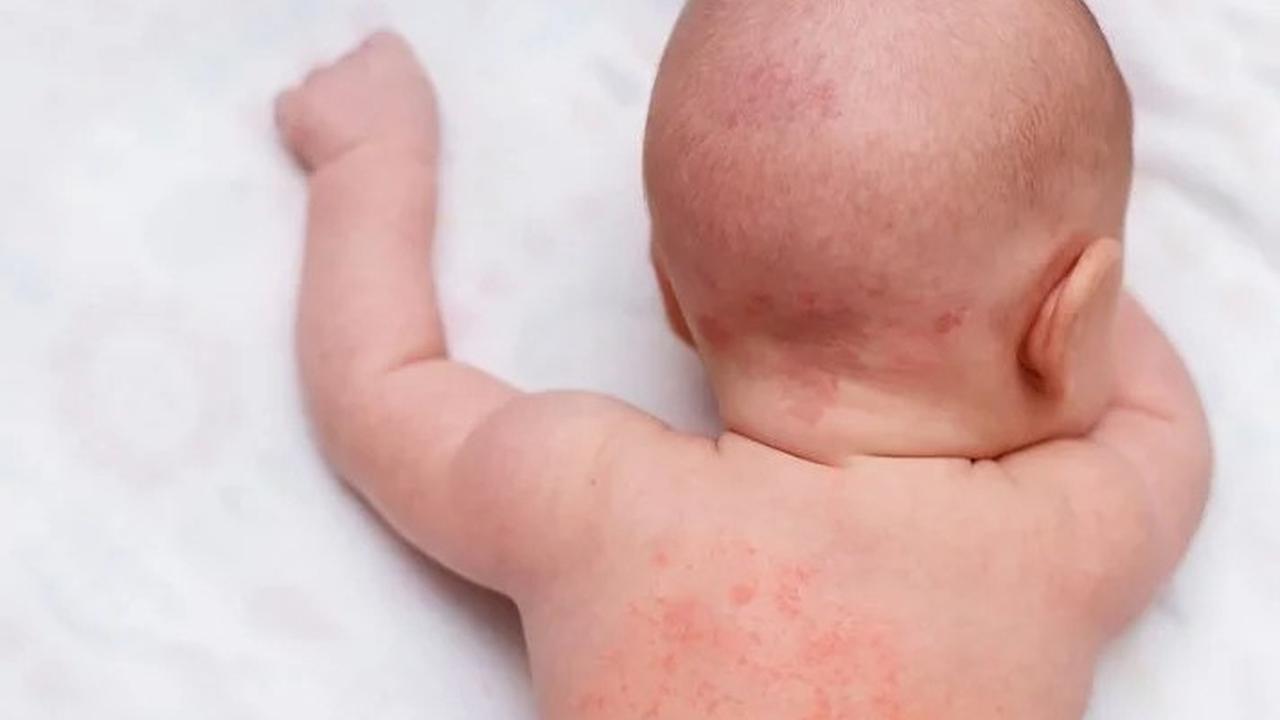 Cara Mengatasi Biang Keringat pada Anak secara Alami