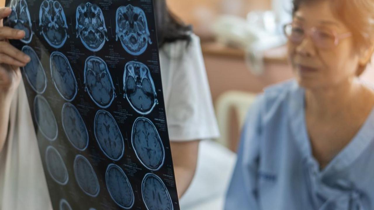 Tanda dan Gejala Stroke yang Perlu Diwaspadai