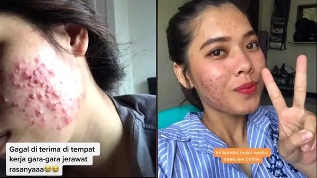 Sudah Lolos Psikotes, Wanita Ini Gagal Diterima Kerja Gara-gara Jerawat