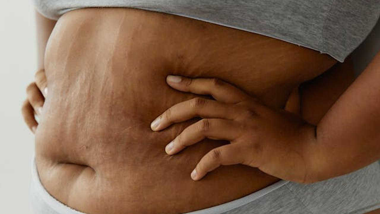 Masalah Kulit yang Bisa Dialami Penderita Obesitas