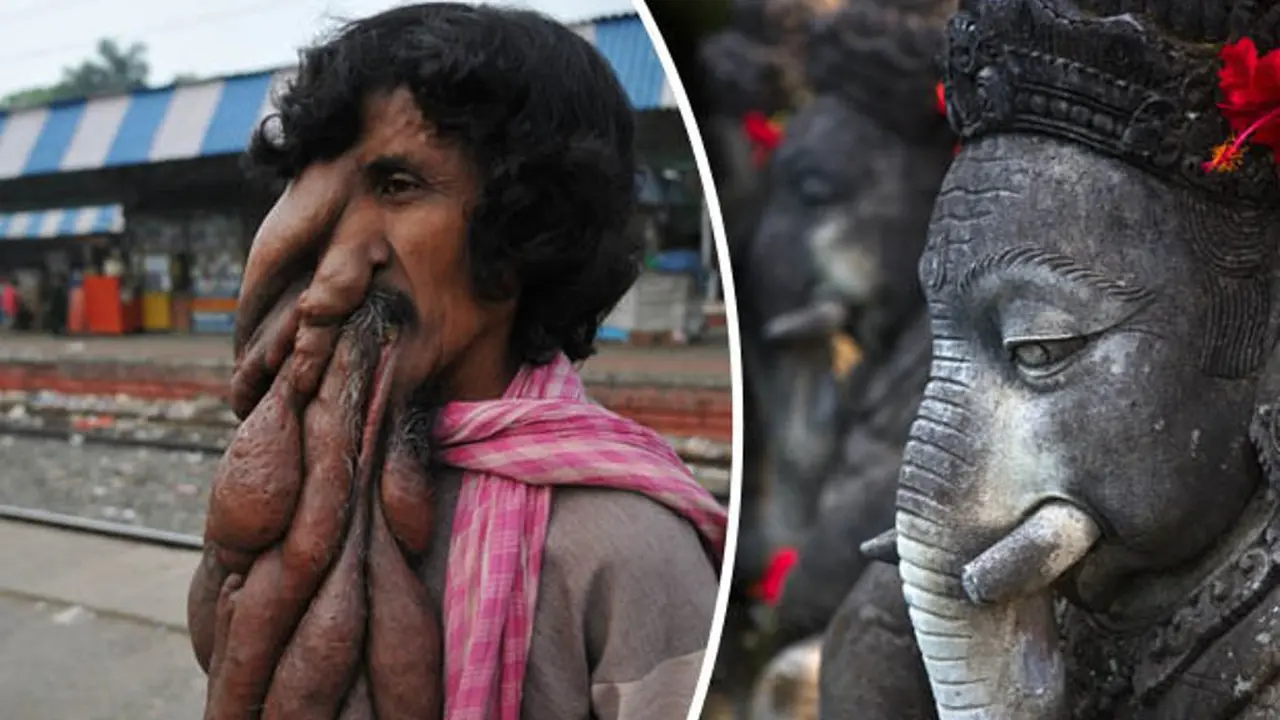 Miliki Belalai Seperti Gajah, Pengemis Ini Dianggap Dewa