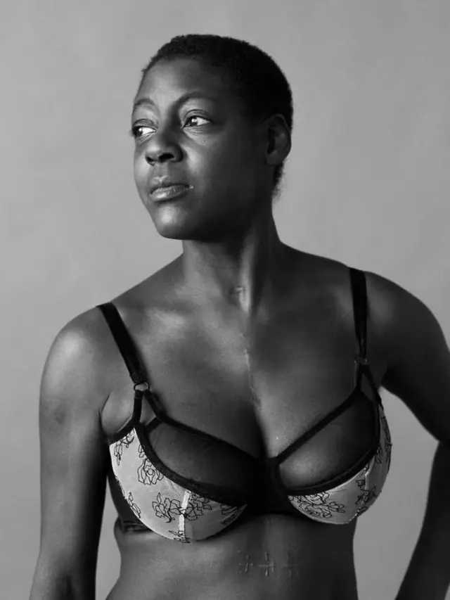 [Bintang] Cerita 5 Wanita dengan Bekas Luka di Tubuhnya, Bikin Terharu