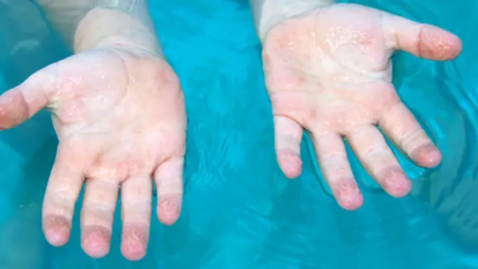 Ini Alasannya Mengapa Jari Jari Anda Keriput Saat Berenang Beauty Fimela Com