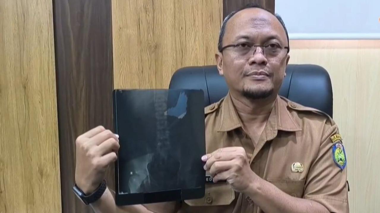 Kondisi Paku di Dalam Perut Berkarat