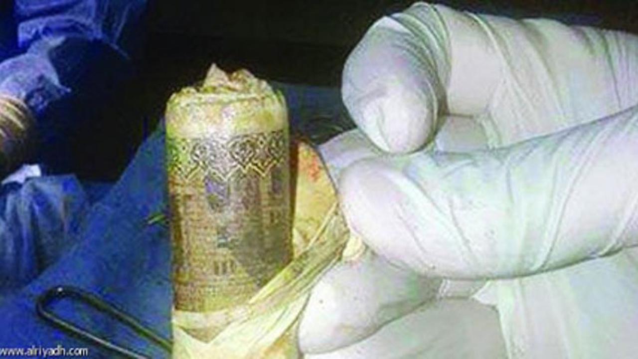 Dikira Usus Buntu, Dokter Malah Temukan Uang dalam Perut Pasien