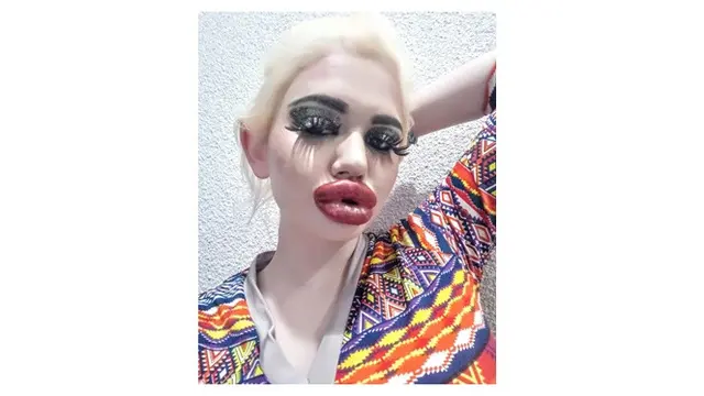 Lakukan 20 Kali Injeksi, Ini 5 Potret Transformasi Wanita Bibir Terbesar