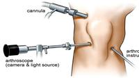 Operasi artroskopi pada cedera lutut ACL dibutuhkan tiga titik sayatan untuk melakukan rekonstruksi pada bagian yang akan diperbaiki. (Foto: www.thaimakeover.com)
