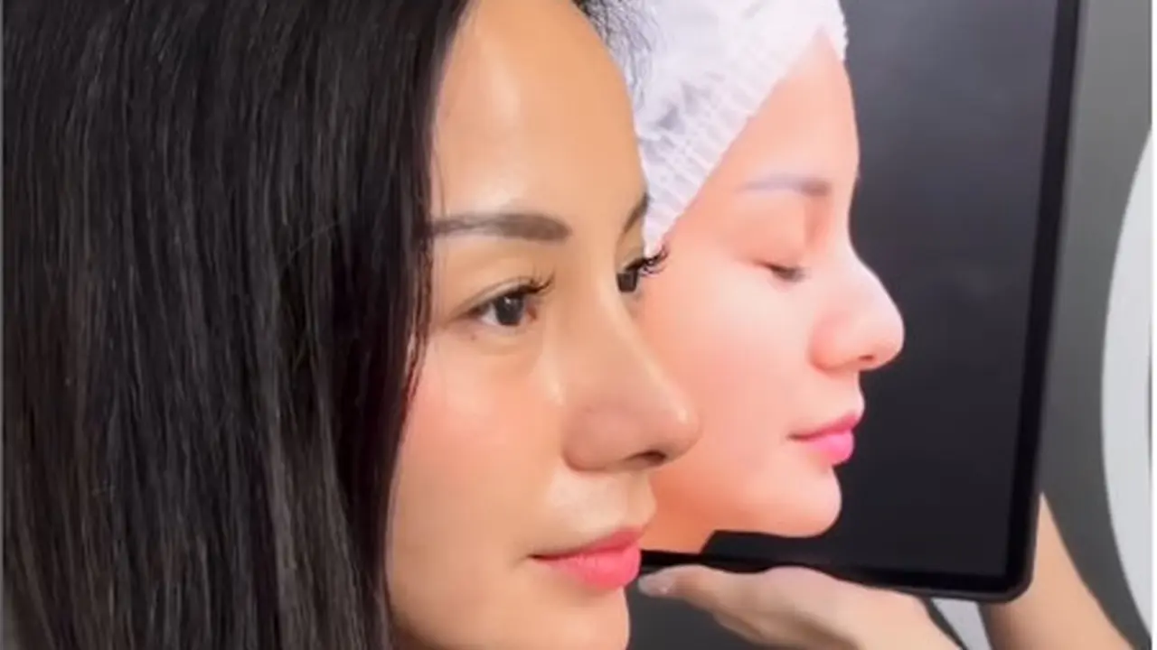 6 Potret Terbaru Kirana Larasati Usai Rhinoplasty, Akui untuk Estetika