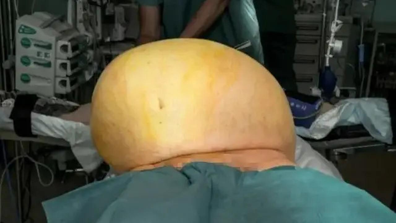 Dicap Gemuk, Pria Ini Ternyata Punya Tumor Seberat 27 Kg di Perut