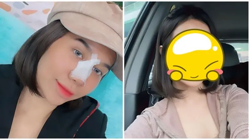 8 Potret Perubahan Wajah Mayang Usai Operasi Hidung, Sudah Lepas Perban