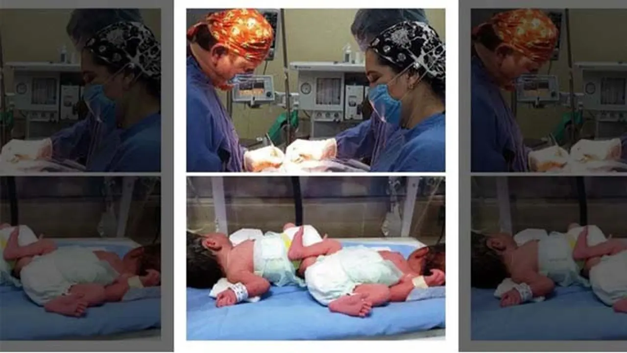 Ajaib, Perempuan 58 Tahun Lahirkan bayi Kembar