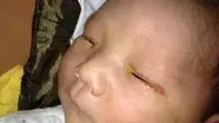 Cahaya flash dari kamera telah merusak sel-sel di sekitar makula yang menyebabkan bayi itu kehilangan penglihatan sentral