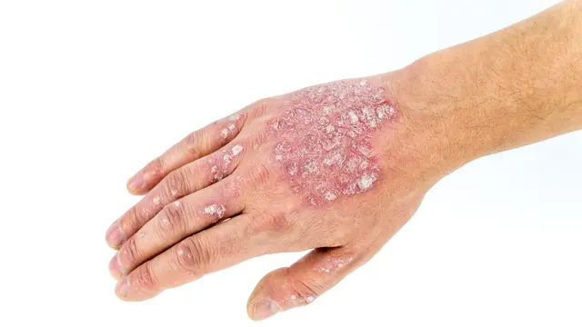 Penyakit Dermatitis