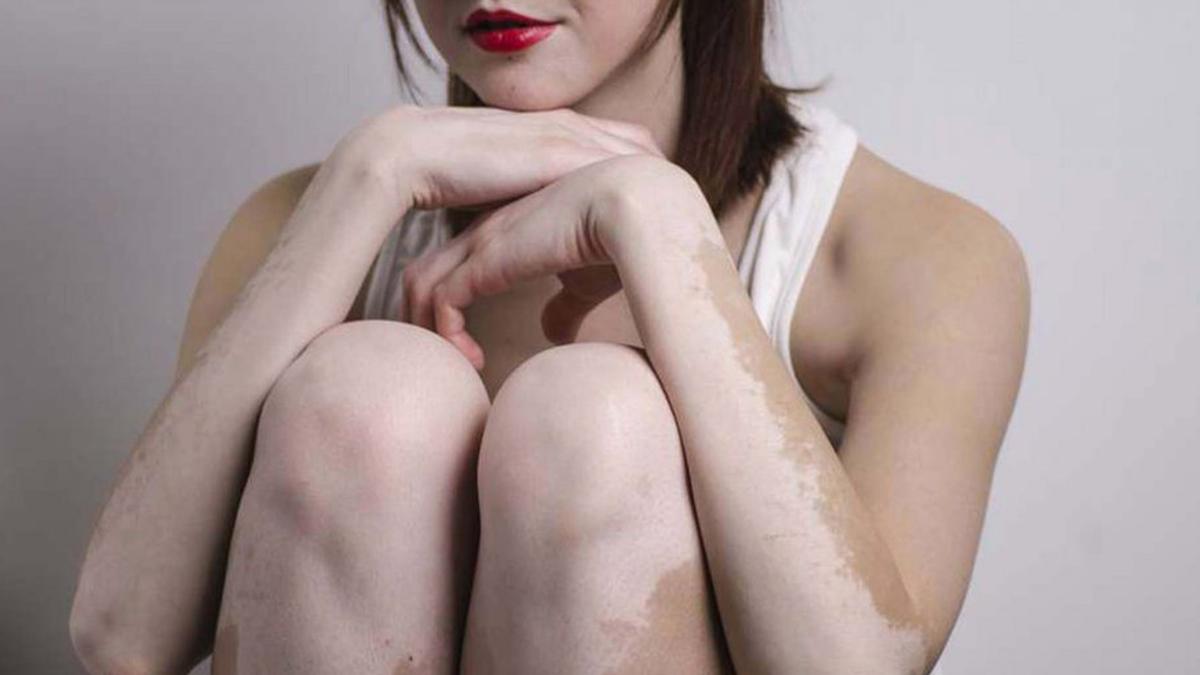 4 Ramuan Alami Atasi Pudarnya Warna Kulit Akibat Vitiligo - Health Liputan6.com