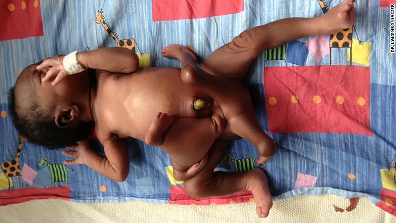 Bertangan dan Kaki 4 Bayi Paul Dioperasi 3 Bulan Kemudian