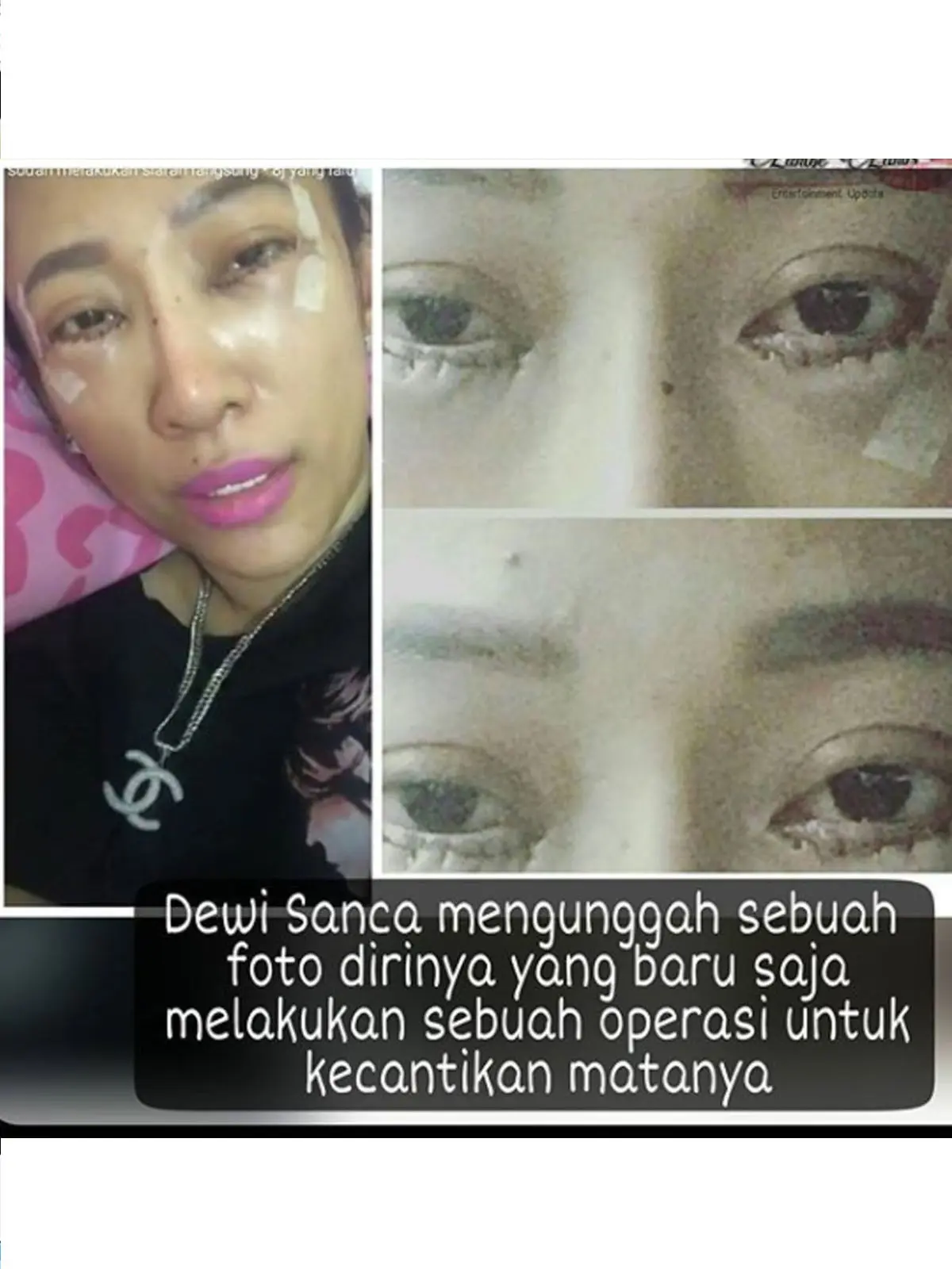 Dewi Sanca mengunggah foto usai menjalani operasi kecantikan di bagian mata. (Instagram)